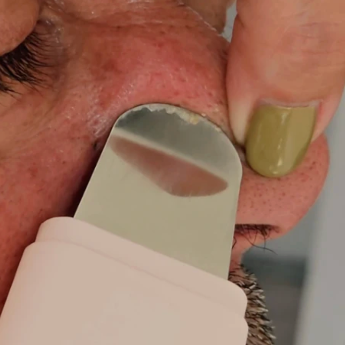 ULTRASONIC PORE EXTRACTOR